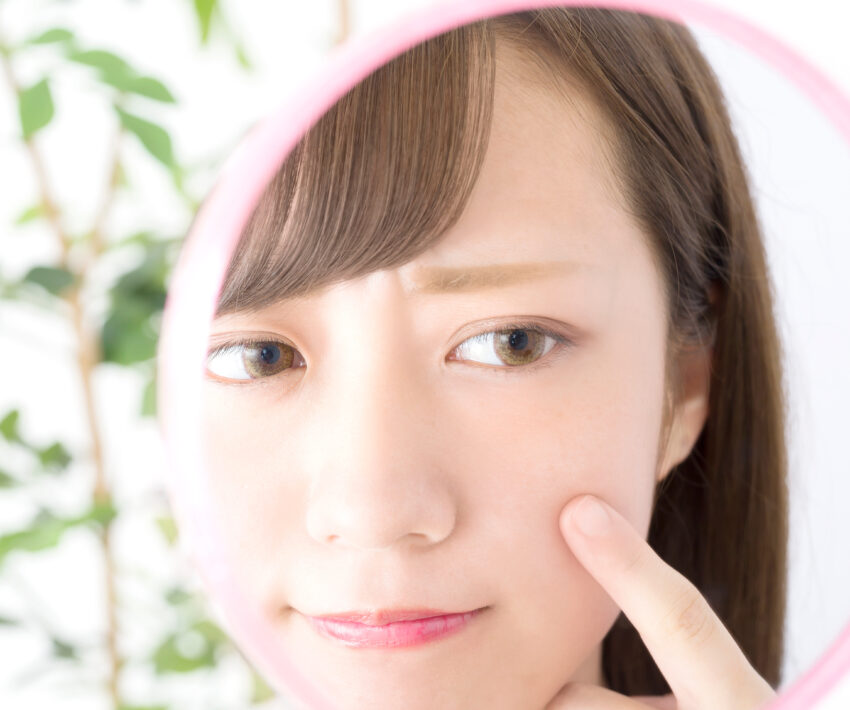 ニキビ・ニキビ跡があっても脱毛はできる！NGなケースも解説