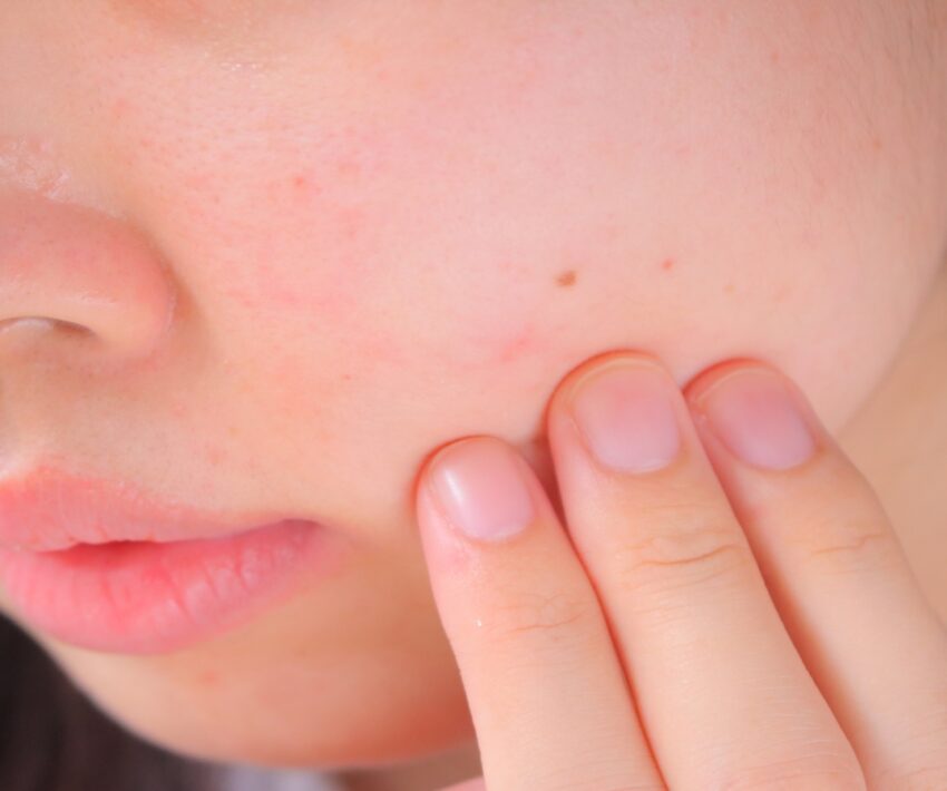 ほくろに医療脱毛はできる？リスクや施術方法について医師が徹底解説！