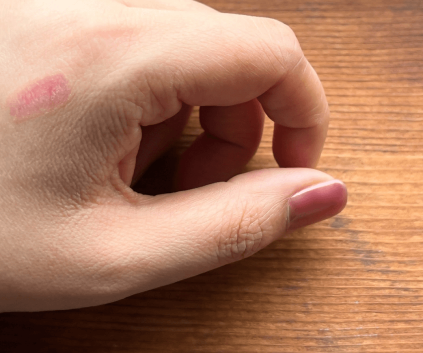 【徹底解説】脱毛でやけどする？原因ややけどの対処法・防止法